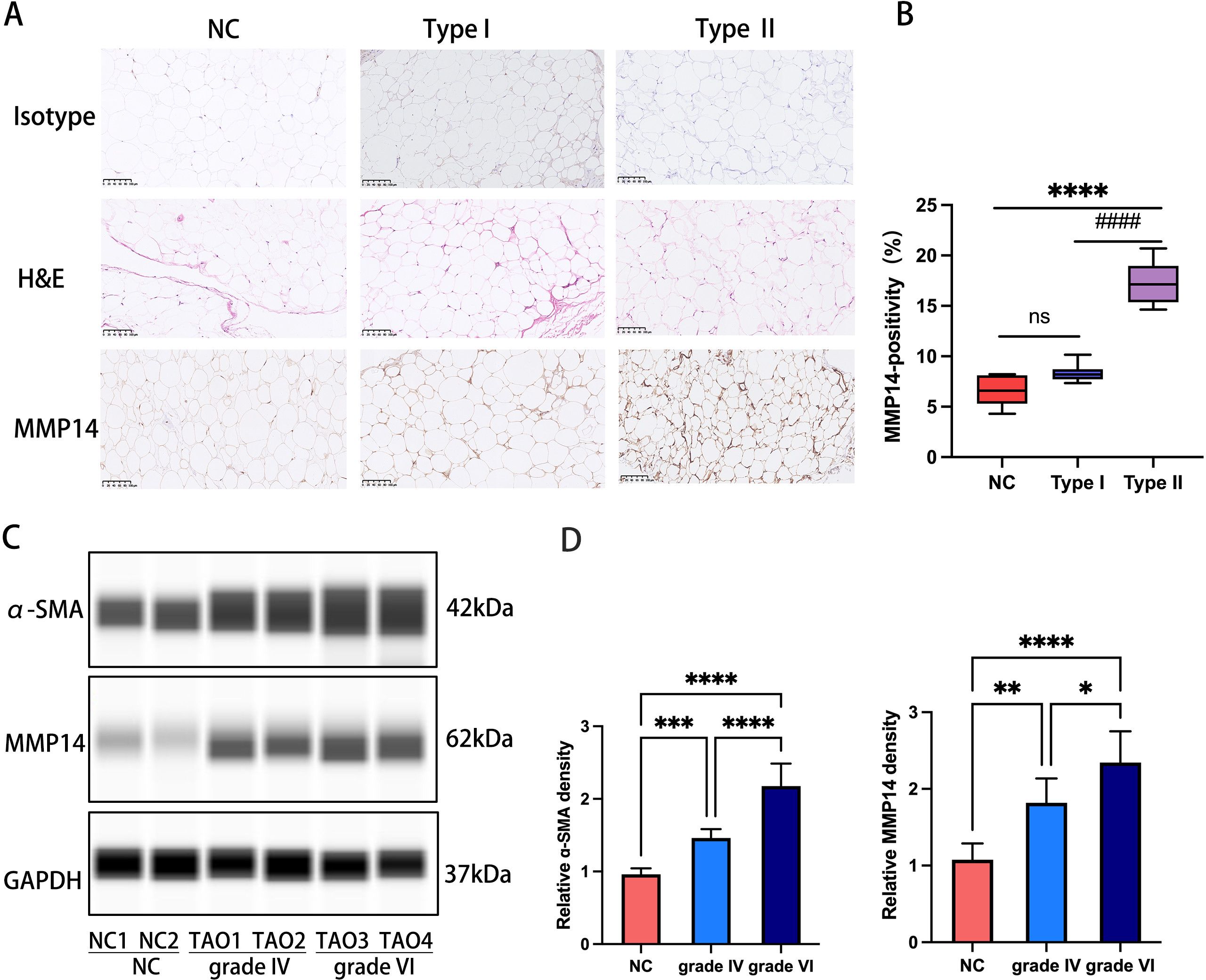 Panel A displays histological images of NC, Type I, and Type II tissues stained with isotype, H&E, and MMP14. Panel B is a box plot showing MMP14-positivity percentages, with significant differences indicated by asterisks. Panel C shows Western blot results for α-SMA, MMP14, and GAPDH across different samples, with protein sizes labeled. Panel D includes bar graphs comparing relative α-SMA and MMP14 densities in NC and grades IV and VI, with significant differences indicated by asterisks. Scale bars and molecular weights are provided for context.