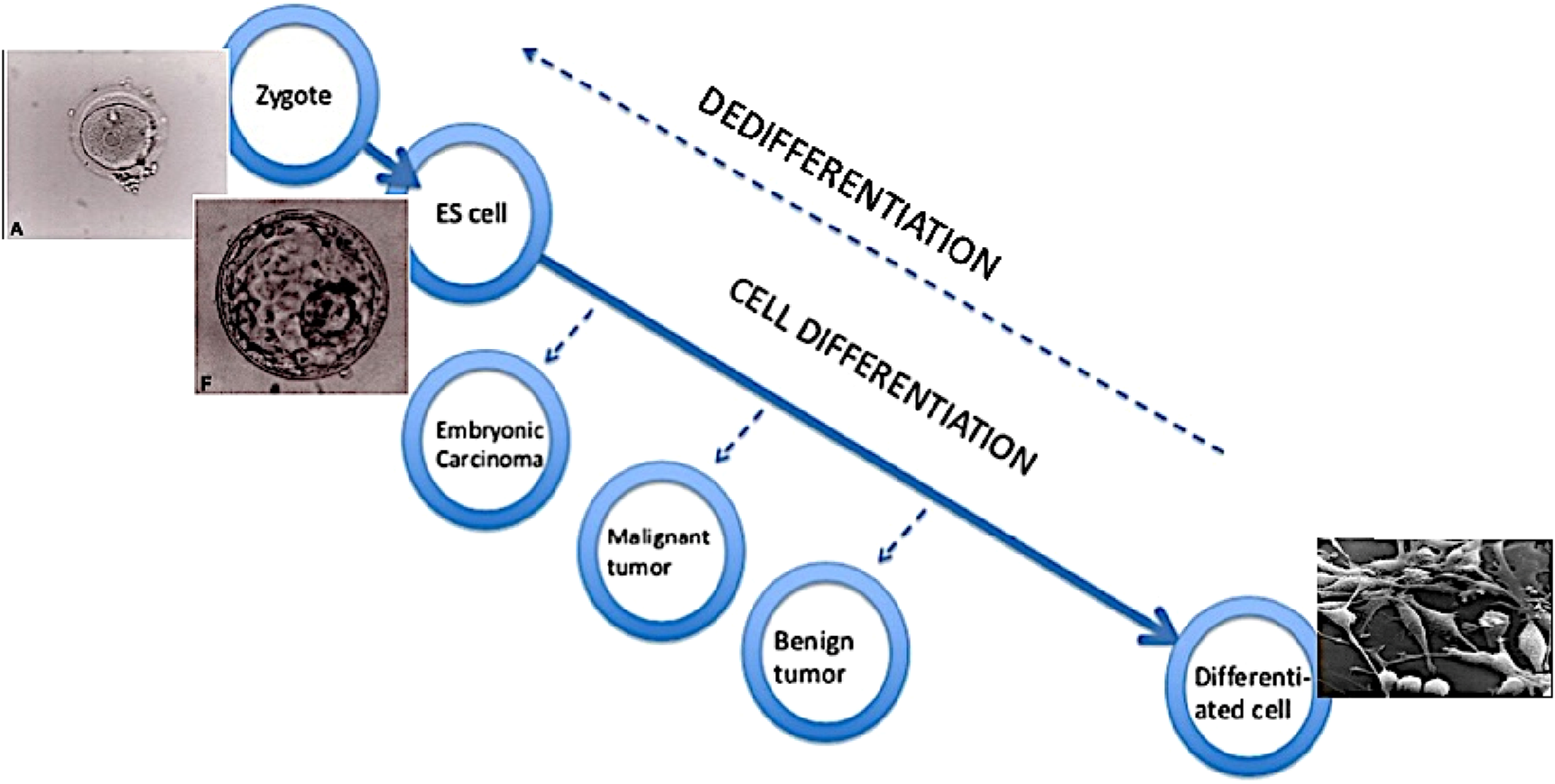Diagram illustrating cell differentiation and dedifferentiation. It shows progression from a zygote to embryonic stem cells, then to differentiated cells. Branches indicate potential development into embryonic carcinoma, malignant tumor, or benign tumor. Images of a zygote, embryonic stem cell, and differentiated cell are included. Arrows show paths of dedifferentiation and differentiation, highlighting the complexity of cell development and transformation.