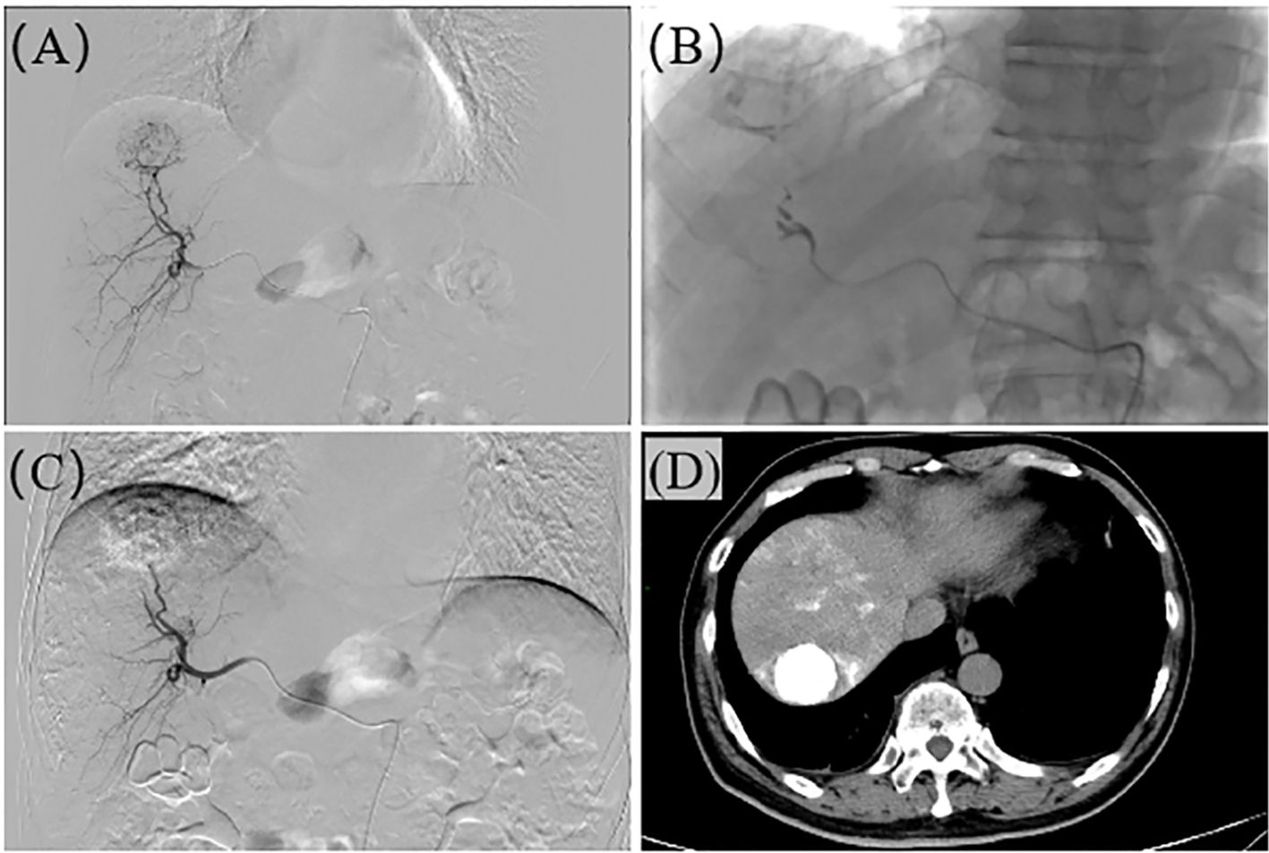 Four-part medical imaging comparison. (A) Angiogram showing detailed blood vessels. (B) X-ray with catheter placement. (C) Angiogram highlighting contrast injection in vessels. (D) CT scan of the abdomen showing internal organs and structure.