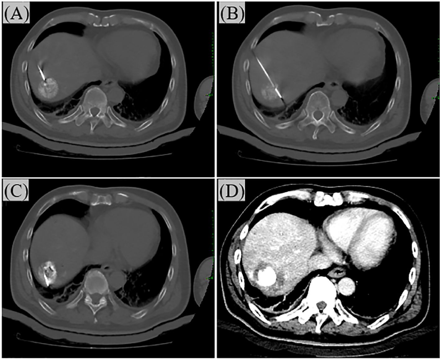 CT scans show sequential stages of a liver procedure. Panel A and B depict a needle inserted into a liver lesion. Panel C shows the liver post-procedure, with a visible lesion. Panel D presents a contrast-enhanced liver scan, highlighting the liver’s internal structure.