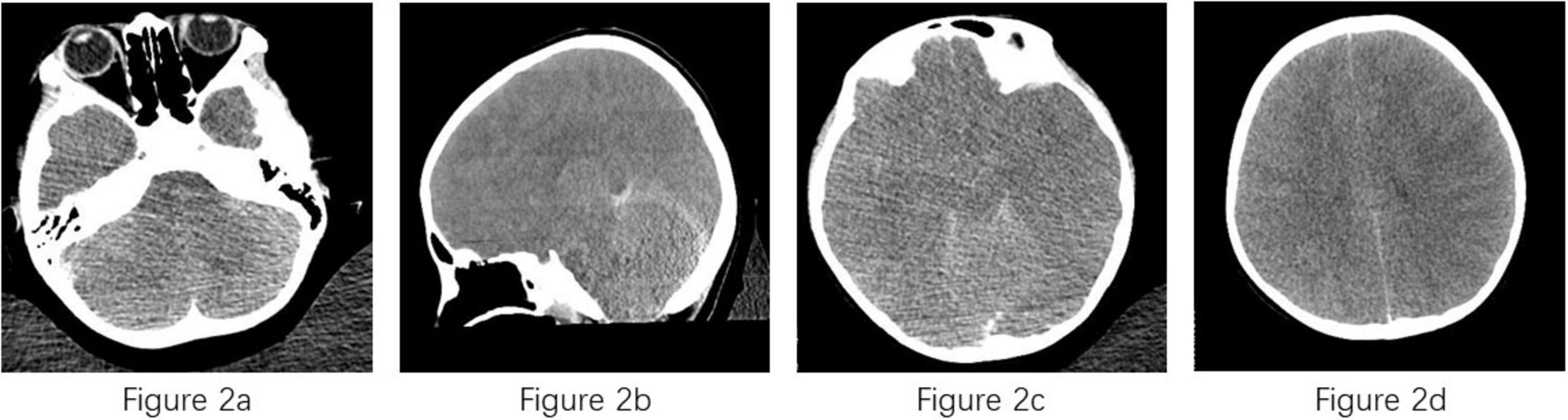 Four CT scan images labeled Figure 2a to 2d show different cross-sectional views of a brain. Figure 2a presents the base of the skull; 2b shows a lateral view; 2c and 2d depict axial views at different levels, highlighting varying brain structures. Each scan varies slightly in the angle and slice of the brain displayed.