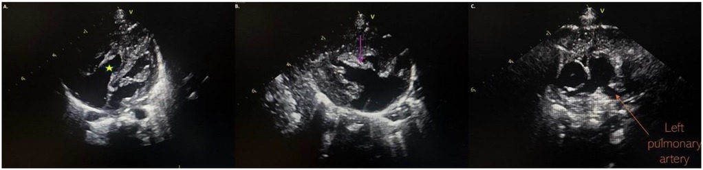 Three echocardiographic images showing different cardiac structures. Panel A highlights a chamber marked with a yellow star, Panel B shows a structure indicated by a purple arrow, and Panel C labels the left pulmonary artery with an arrow. The images demonstrate standard echocardiographic visualization of heart anatomy and vascular connections.