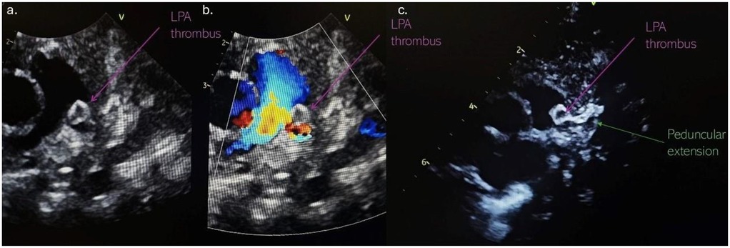 Three echocardiographic images showing a thrombus in the left pulmonary artery (LPA). Panel a highlights the thrombus with a purple arrow, Panel b shows the thrombus with color Doppler flow disturbance, and Panel c demonstrates the thrombus with a peduncular extension labeled in green.