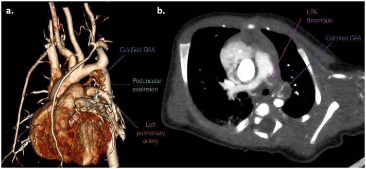 Panel a shows a 3D reconstructed CT angiography of the thoracic vasculature highlighting a calcified ductus arteriosus aneurysm (DAA), a peduncular extension, and the left pulmonary artery. Panel b is an axial CT slice identifying a thrombus in the left pulmonary artery adjacent to the calcified DAA.