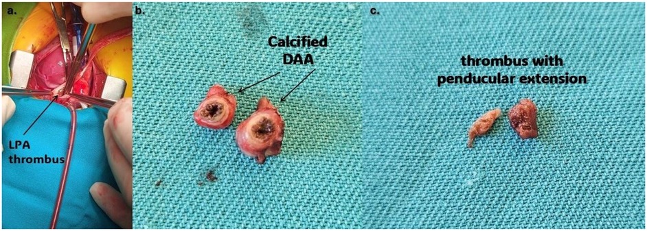 Three surgical images documenting findings. Panel a shows intraoperative exposure of the heart and great vessels with forceps pointing to a thrombus in the left pulmonary artery (LPA). Panel b displays two excised cross-sections of a calcified ductus arteriosus aneurysm (DAA) placed on a surgical drape. Panel c shows a removed thrombus with a peduncular extension.