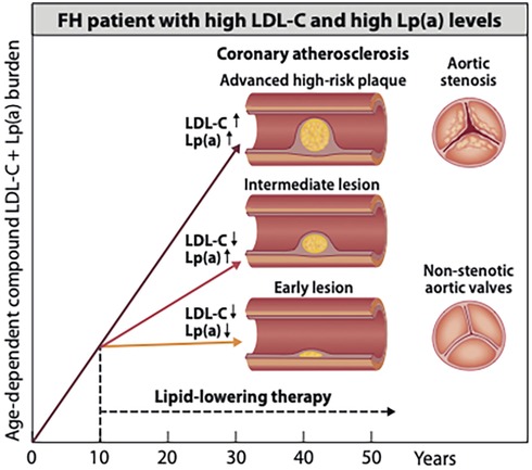 Graph showing the progression of coronary atherosclerosis in FH patients with high LDL-C and Lp(a) levels. It features three artery cross-sections illustrating early, intermediate, and advanced lesions. An adjacent diagram compares aortic stenosis and non-stenotic aortic valves. Time in years is plotted against age-dependent LDL-C and Lp(a) burden, with arrows indicating effects of lipid-lowering therapy.