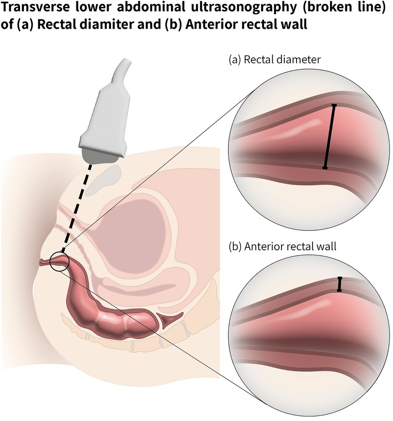 Diagram illustrating the transverse lower abdominal ultrasonography process. A probe is positioned on the abdomen with a dashed line indicating its path to assess the rectal diameter and anterior rectal wall. Enlarged sections show measurements of the rectal diameter (a) and anterior rectal wall (b).