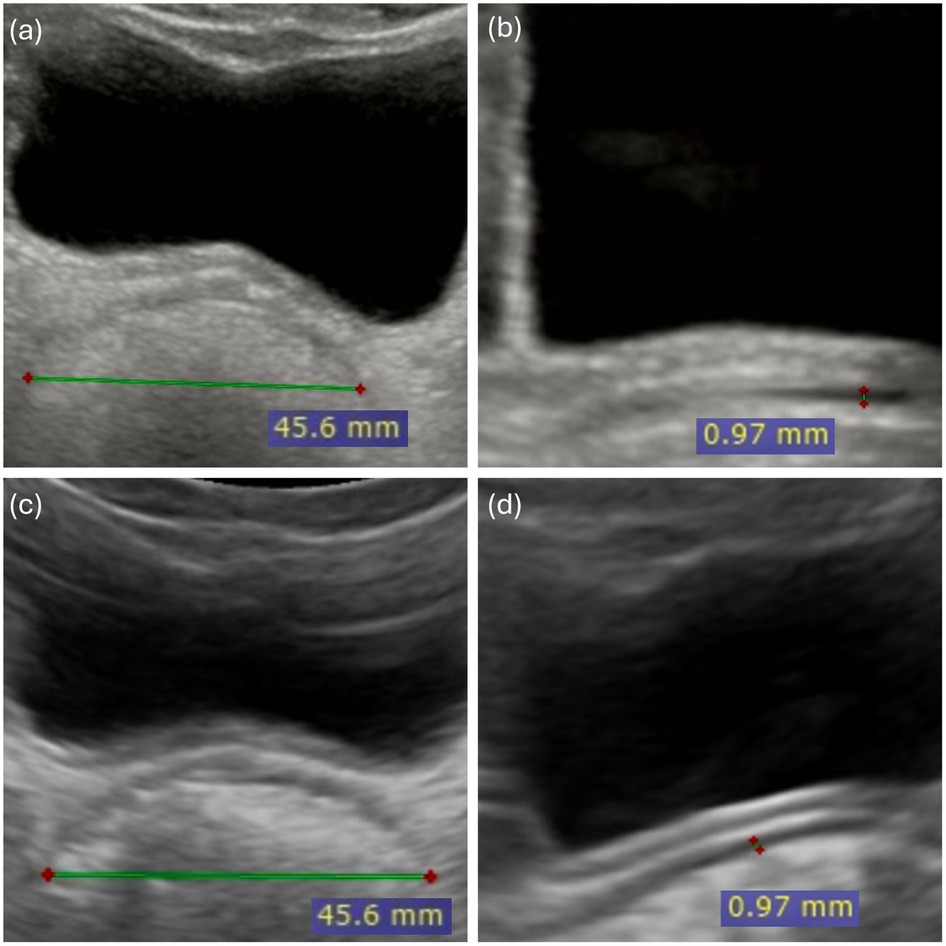 Four ultrasound images in a grid. The top left and bottom left images show a horizontal measurement of a structure labeled as 45.6 millimeters. The top right and bottom right images depict a vertical measurement labeled as 0.97 millimeters.