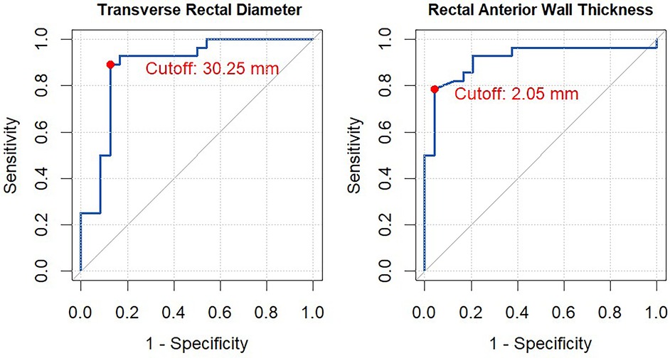 Receiver Operating Characteristic (ROC) curves for transverse rectal diameter and rectal anterior wall thickness. The left graph shows a cutoff of 30.25 mm, and the right graph shows a cutoff of 2.05 mm. Both graphs plot sensitivity versus 1-specificity, marked with blue lines and cutoff points indicated in red.