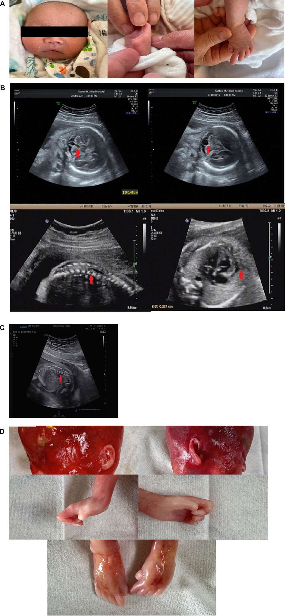 Panel A shows three images of a newborn: a frontal view, hands being examined, and feet being held. Panel B contains four ultrasound images with arrows indicating specific areas of interest within the scans. Ultrasound image shows a prenatal scan with an arrow indicating a specific area. Below, postnatal images display a newborn with distinct physical characteristics including facial features, hands, and feet.