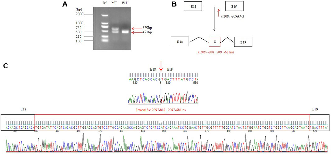 Panel A shows a gel electrophoresis with bands at 579 bp and 451 bp. Panel B is a diagram of genetic sequences with exons E18 and E19, indicating a mutation from c.2097-809A>G. Panel C presents a DNA sequencing chromatogram with highlighted intron 18 mutation c.2097-808_2097-681ins.