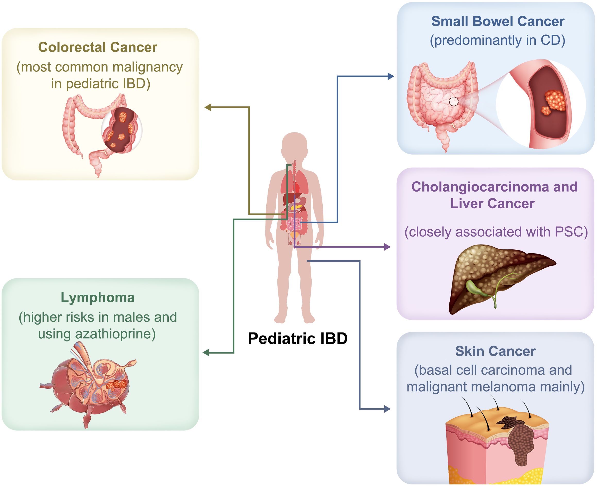 Diagram showing associations between pediatric IBD and various cancers. Colorectal cancer is noted as the most common malignancy; small bowel cancer is linked predominantly with CD; cholangiocarcinoma and liver cancer correlate with PSC; lymphoma shows higher risks in males using azathioprine; skin cancer includes basal cell carcinoma and melanoma. Central illustration of a child highlights affected regions.