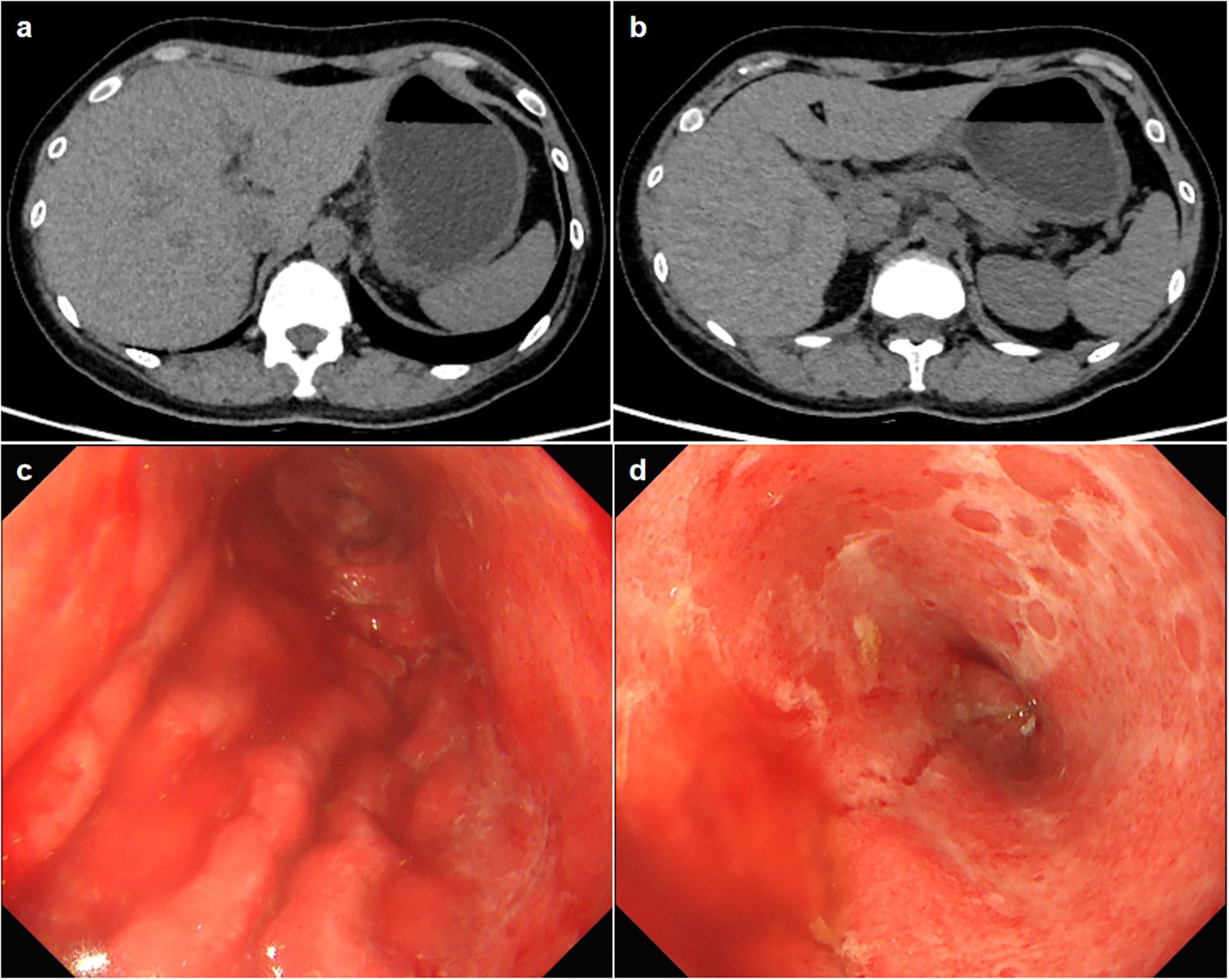 CT scans labeled “a” and “b” show cross-sectional abdominal images with varying tissue densities. Endoscopic images “c” and “d” display the interior of a digestive organ with inflamed, reddened tissue and notable texture differences.