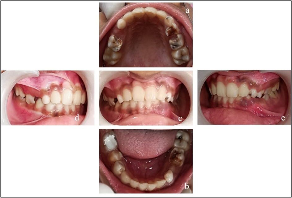 Five images showing dental examinations with labels: (a) upper teeth with cavities, (b) lower teeth with decay, (c) frontal view showing prominent front teeth, (d) left side view showing alignment, (e) right side view showing occlusion.