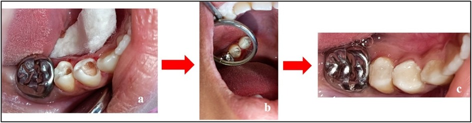 Three-panel image showing a dental procedure sequence. Panel a: Tooth preparation with a cavity exposed. Panel b: A dental mirror shows the cavity’s interior. Panel c: Completed dental filling with a shiny metal amalgam restoration. Red arrows indicate the progression.