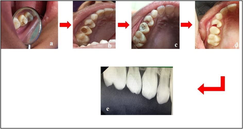 Series of dental images showing stages of tooth treatment. (a) Decay visible in a molar using a mirror. (b) Closer view of the decayed tooth. (c) Tooth appears drilled with internal decay. (d) Finished filling with a smooth surface. (e) X-ray of the tooth from the side, focusing on the roots. Red arrows indicate progression.