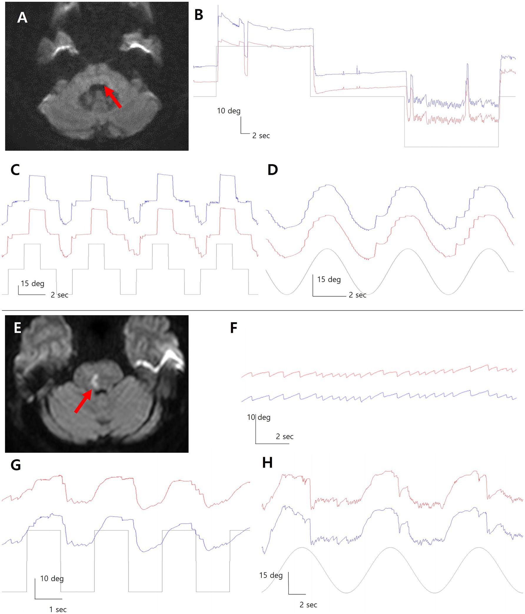 Panel A and E show brain MRI scans with red arrows indicating a specific region. Panels B, C, D, F, G, and H display line graphs with blue and red lines, showing data over time with amplitudes in degrees marked on the y-axis and seconds on the x-axis. The graphs demonstrate different patterns of activity.