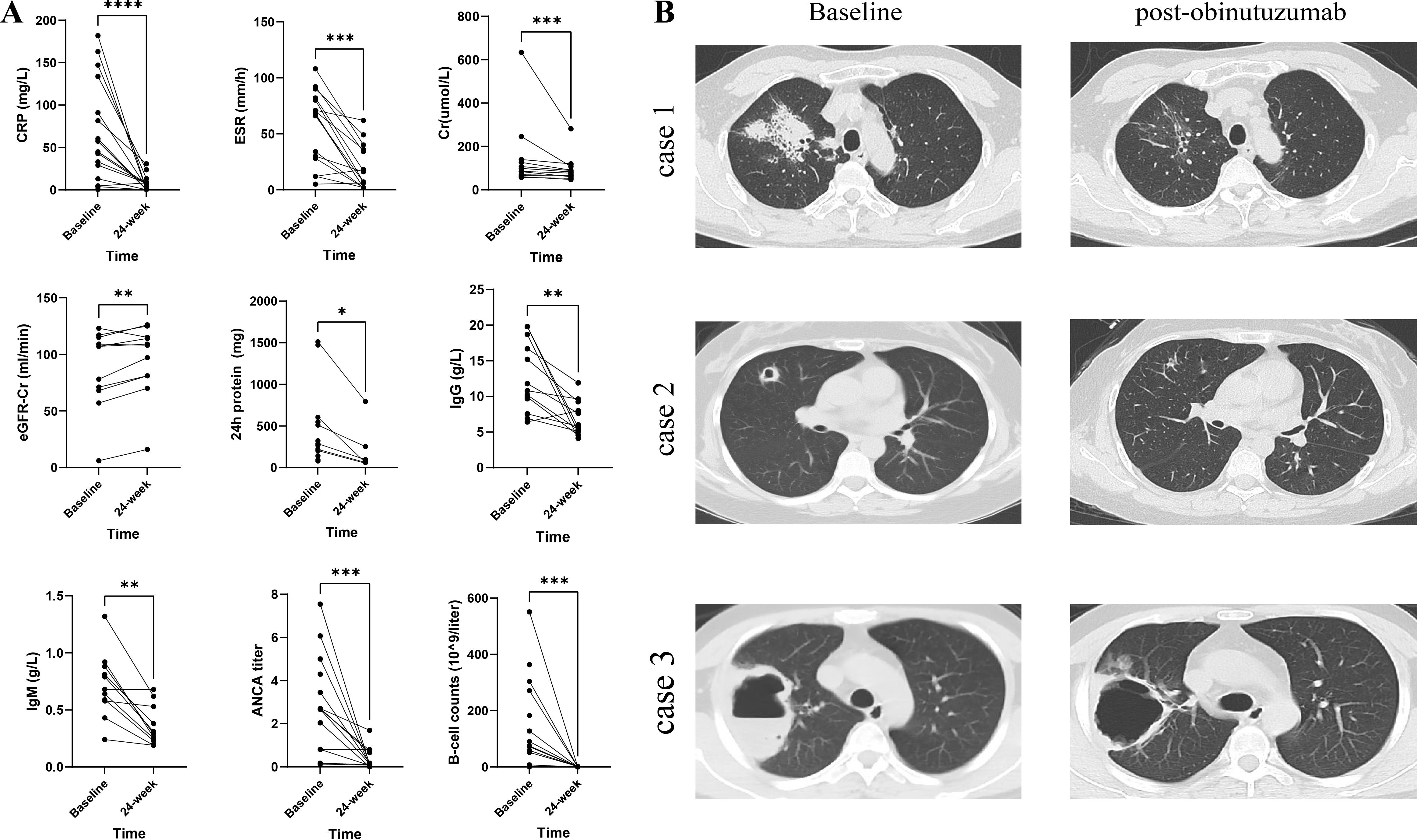 Graphs on the left (A) show various biomarkers, including CRP, ESR, and eGFR, with significant changes from baseline to twenty-four weeks, marked by asterisks for statistical significance. The right panel (B) displays CT scans of three cases, showing lung changes from baseline to post-obinutuzumab treatment.