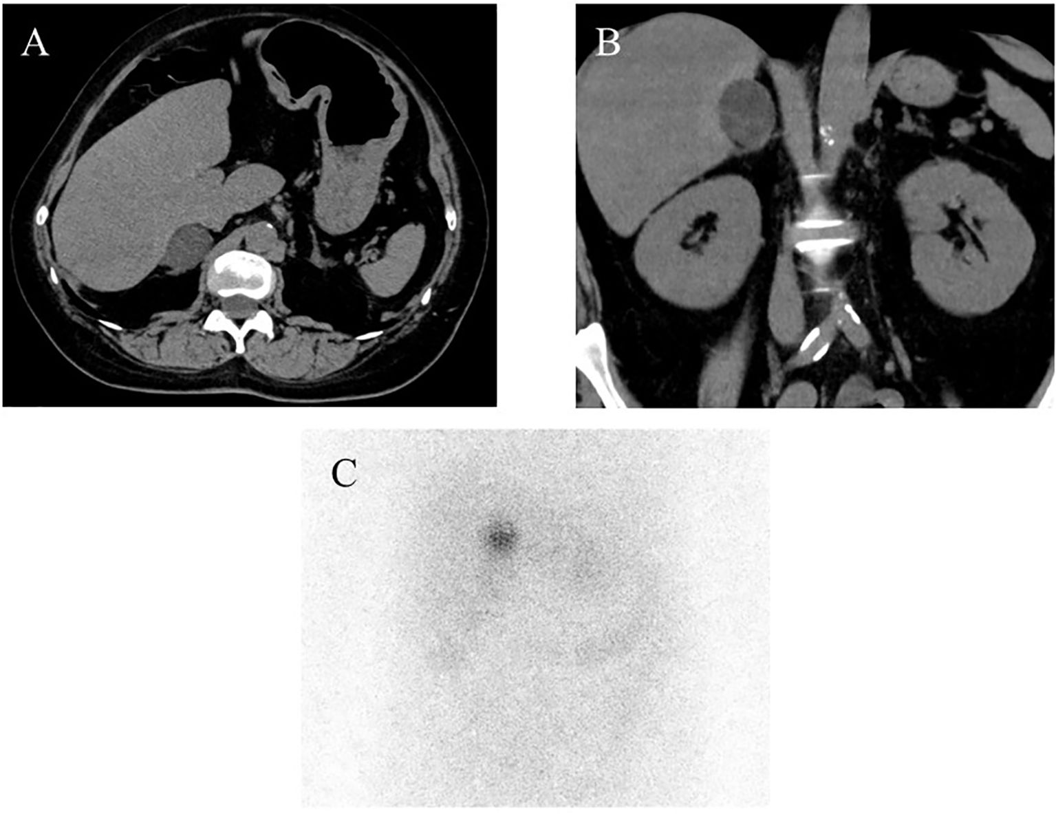 CT scan images showing cross-sectional views of the abdominal region: Panel A presents an axial view, while Panel B shows a coronal view, both highlighting the adrenal glands. Panel C depicts a grayscale image, likely a scintigraphy, with a distinct dark spot, possibly indicating an area of interest or abnormality.