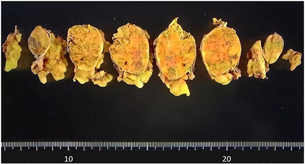 Slices of a yellowish tumor against a black background with a horizontal ruler indicating the size in centimeters.