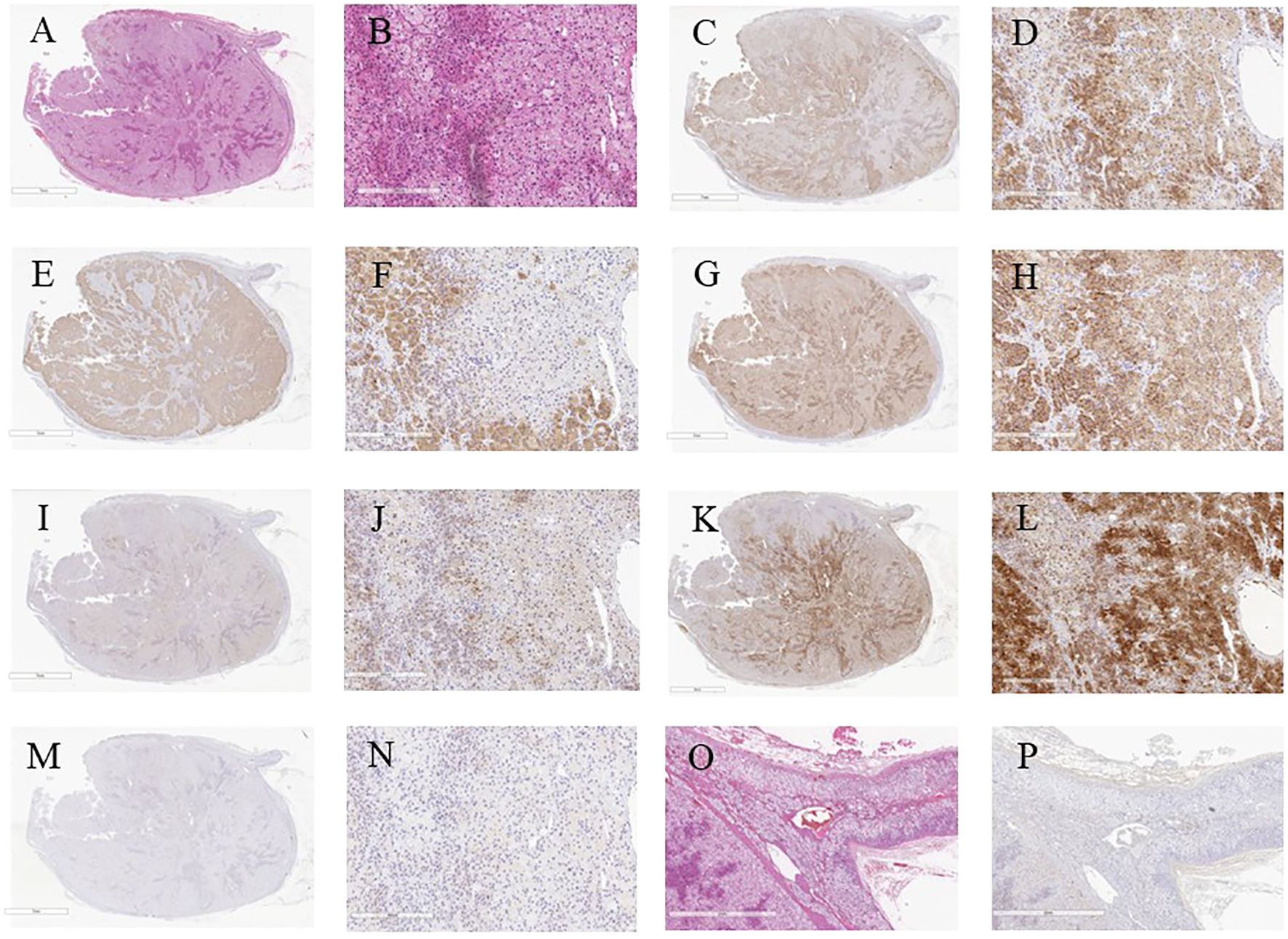 A grid of sixteen histological images labeled A to P, showing tissue samples with varying staining techniques. A, C, E, G, and K provide whole tissue sections, while B, D, F, H, and L provide magnified views of tissue details. O and P provide adjacent non-neoplastic adrenal gland. Staining patterns change across the images, indicating different marker expressions or conditions.