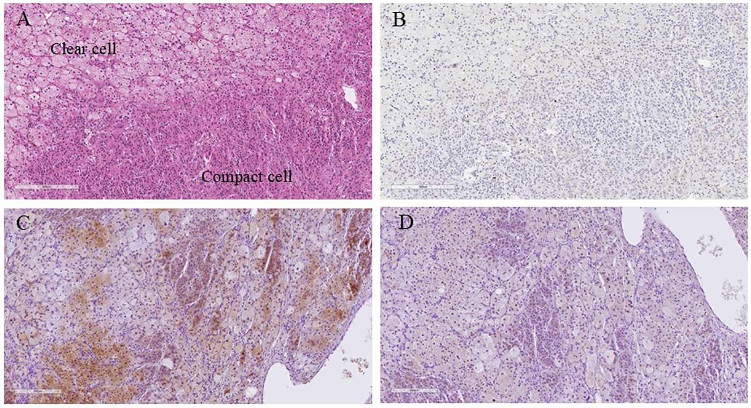 Higher magnification microscopic images of the tumor. A provide clear and compact cells. B provide Ki-67 expression. C and D shows co-expression of Cytochrome b5 and DHEA-ST.