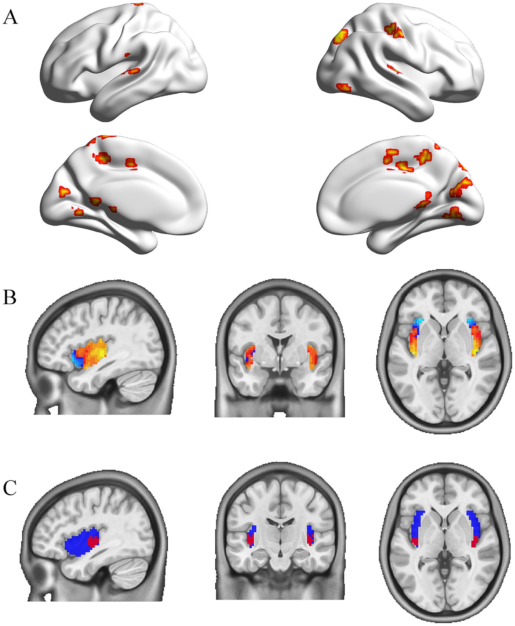 Brain imaging with three panels labeled A, B, and C. Panel A shows 3D brain models with highlighted regions in red and yellow. Panel B presents sagittal, coronal, and axial MRI slices with highlighted areas in orange and blue. Panel C displays similar MRI slices with highlighted regions in blue and red. Each panel illustrates different brain regions and activation patterns.