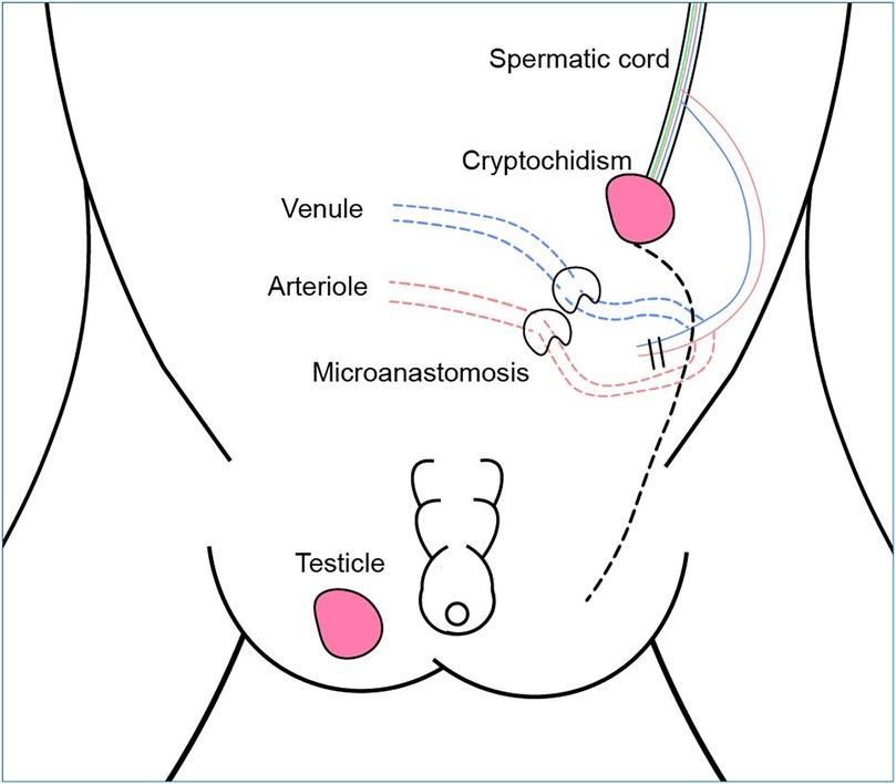 Diagram illustrating male anatomy related to cryptorchidism surgery. Labels include \