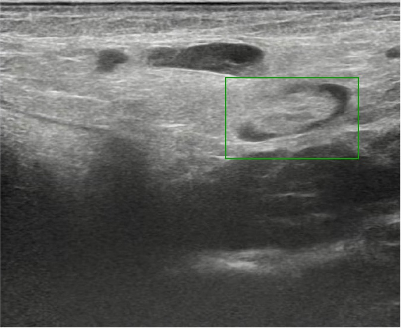 Ultrasound image showing a large fluid collection beneath the skin surface, indicated by a dark area within a marked square. Surrounding tissues are lighter and have varied textures, suggesting different densities.