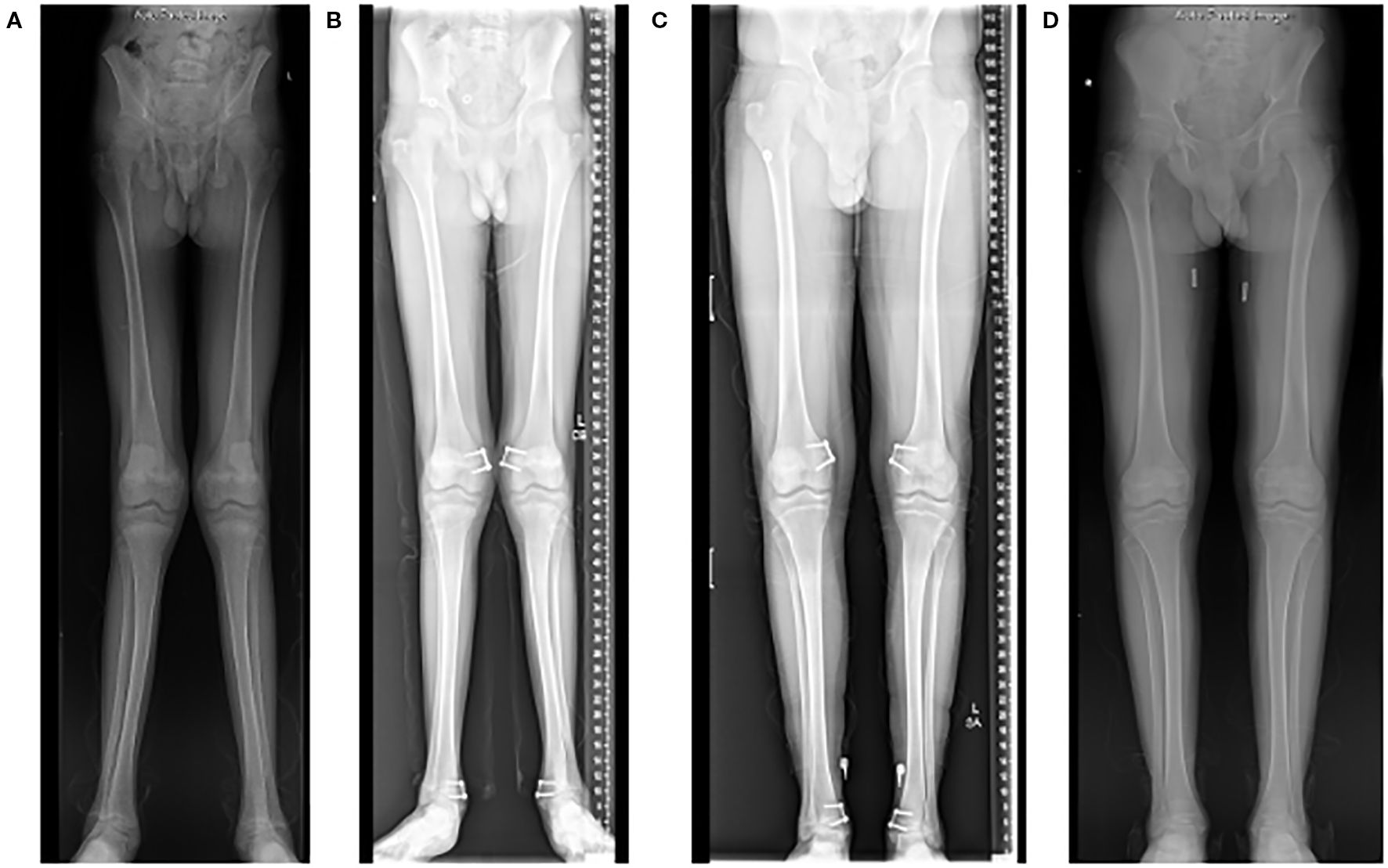 X-ray images of lower limbs in four panels labeled A, B, C, and D. Panels show varying alignment and positioning of bones from hips to feet, with visible signs of surgical implants or devices near the knees in panels B and C.