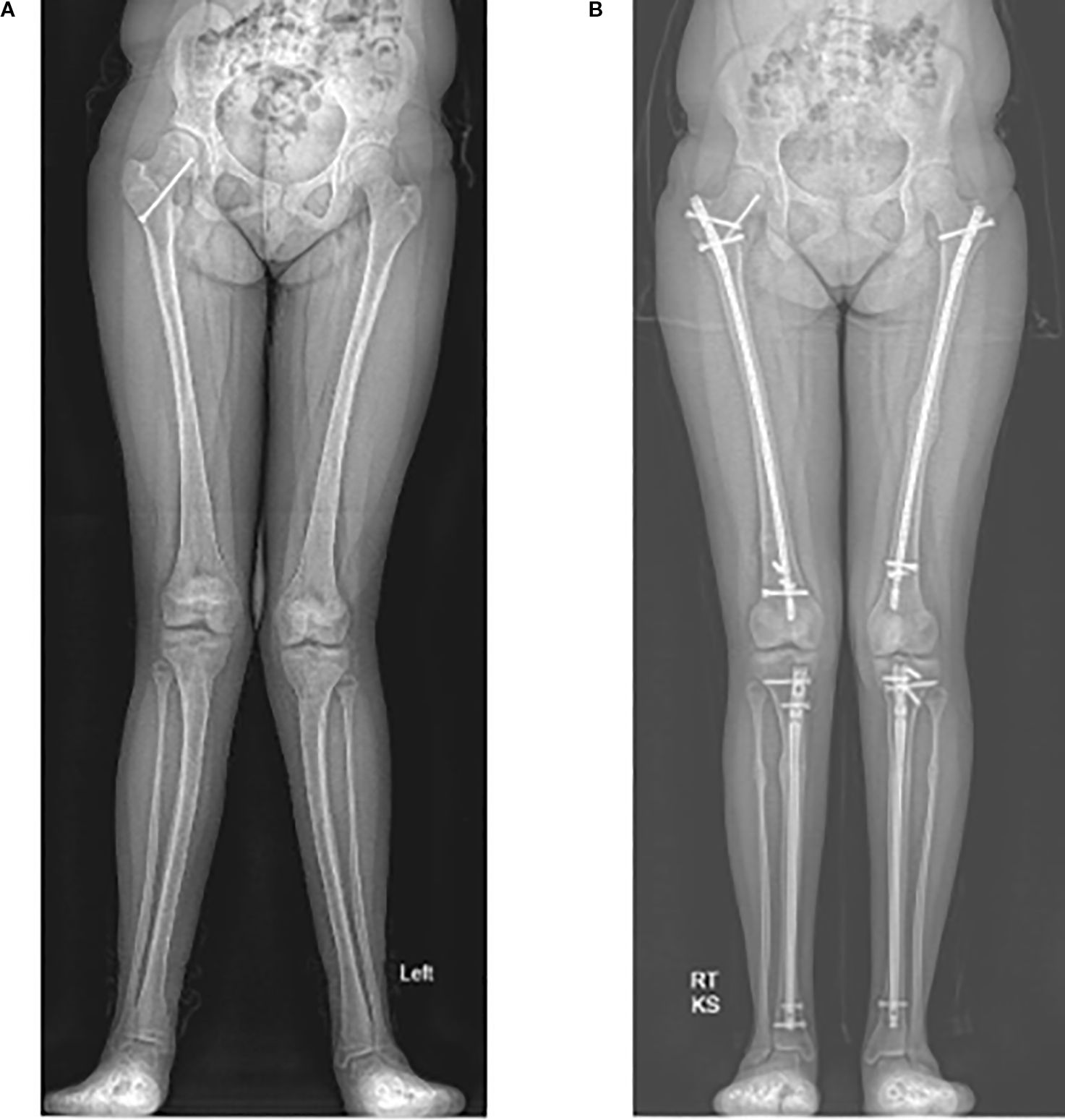 Two X-ray images show lower limbs. Image A depicts unaligned leg bones with visible deformity. Image B shows post-surgical correction with metal screws and rods aligning the bones accurately.
