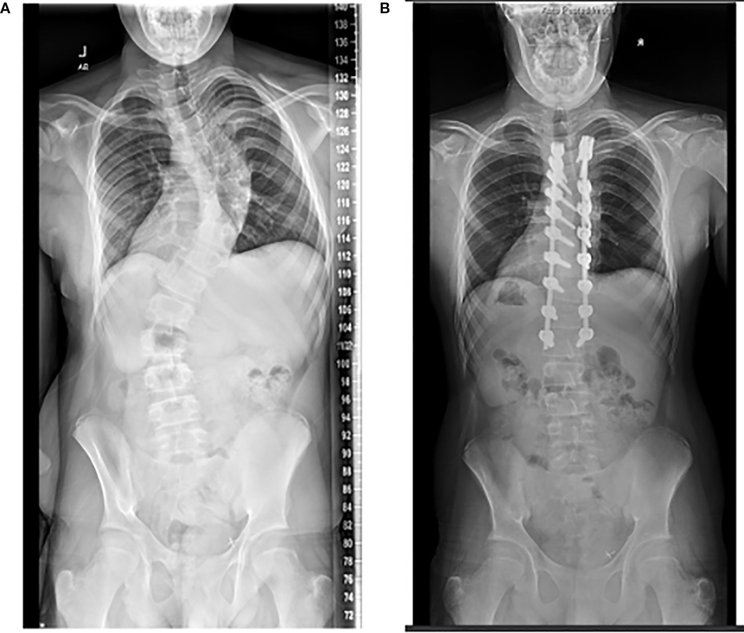 X-ray images showing the torso of a person. Image A displays a spine with a significant lateral curvature indicative of scoliosis. Image B shows the same spine post-surgery with a straight alignment, supported by metal rods and screws.