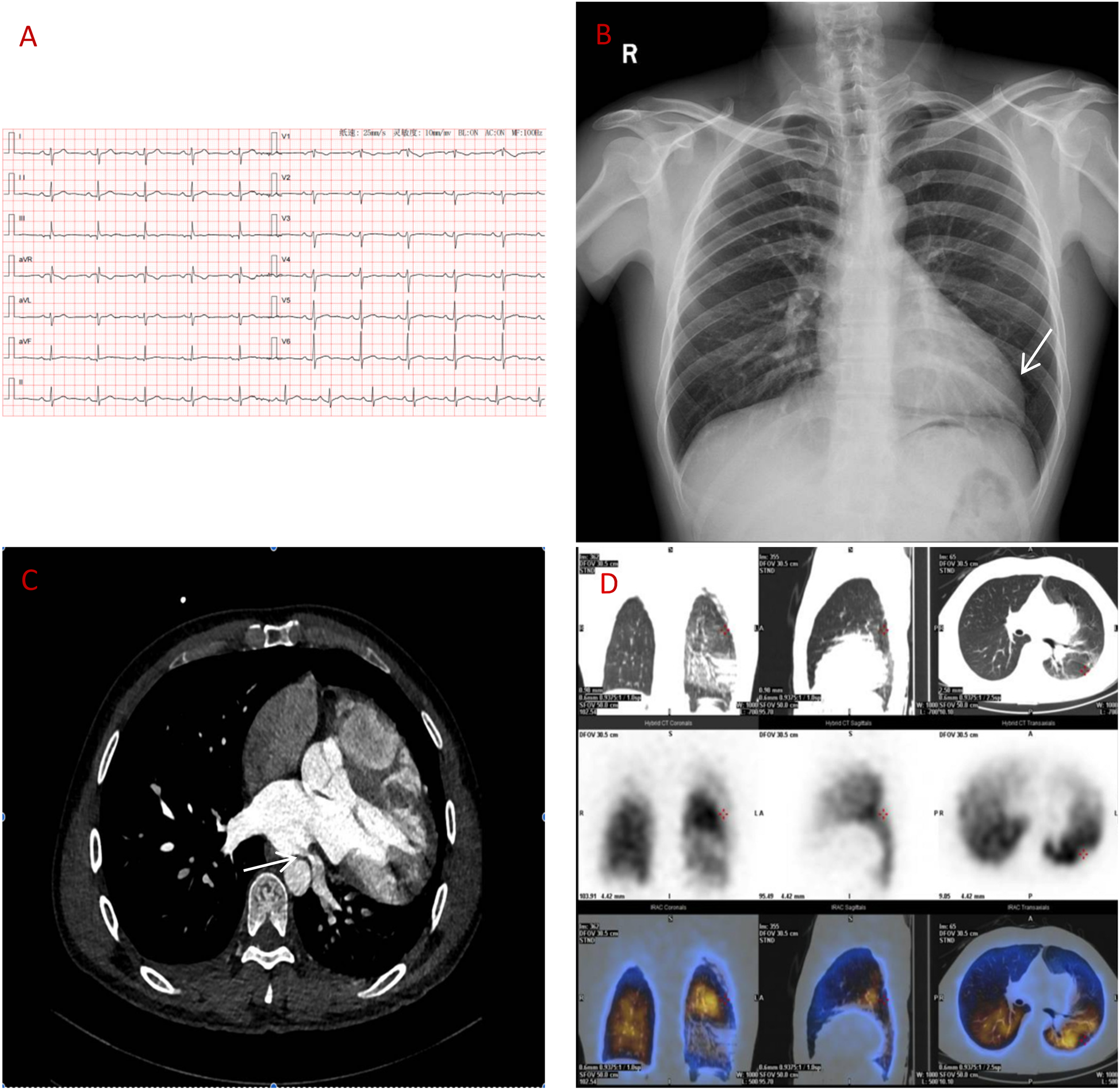 A series of medical images, labeled A to D: (A) An electrocardiogram with several tracings on grid paper. (B) A chest X-ray showing lungs and a white arrow pointing to a specific area. (C) A CT scan displaying a cross-section of the chest, highlighting organs. (D) Multiple CT and PET scan images showing cross-sectional and side views of the chest, emphasizing different areas.
