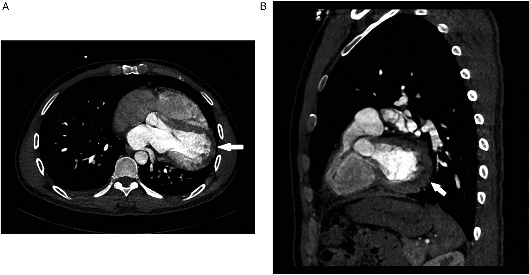 Two-panel contrast-enhanced CT images of the thorax. Panel A shows an axial view with a white arrow indicating a soft tissue mass adjacent to the heart. Panel B presents a sagittal view highlighting the same mass with a white arrow, suggesting its location and extent relative to surrounding thoracic structures.