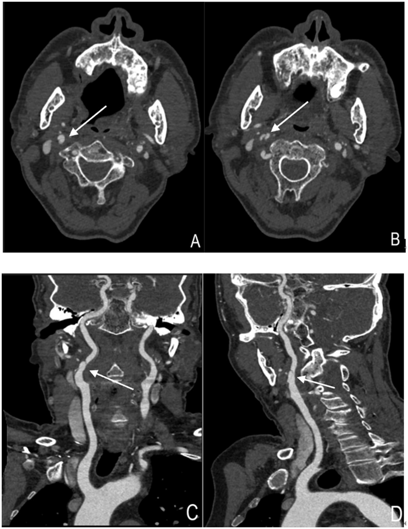 CT scans in four panels labeled A to D. The double-lumen sign in the carotid artery axial view is indicated by the arrows in Figures A and B; the double-lumen sign in the coronal and sagittal planes is indicated by the arrows in Figures C and D.