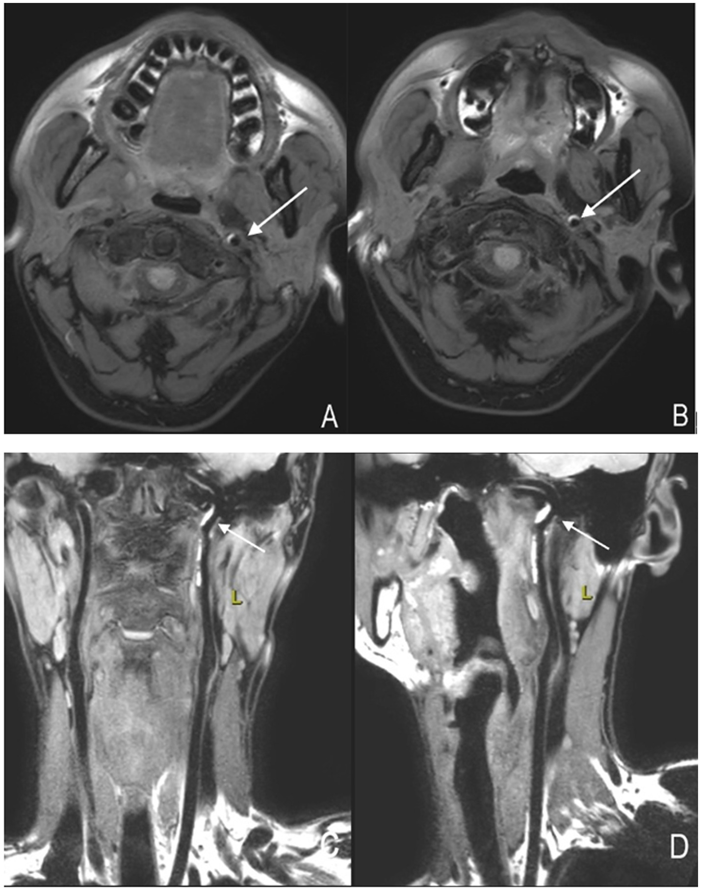 MR scans in four panels labeled A to D. The crescent-shaped high signals indicated by the arrows in Figures A and B represent intramural hematoma of the carotid artery in the transverse section; the high signals indicated by the arrows in Figures C and D represent intramural hematoma of the carotid artery in the coronal and sagittal sections.