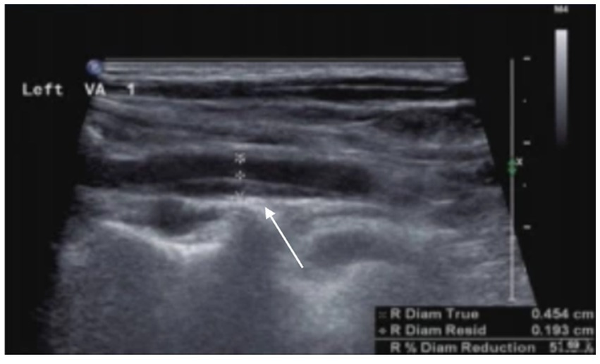 The arrow indicates a dissection of the left vertebral artery as shown by ultrasound imaging. A hematoma is visible on the posterior wall of the vertebral artery, causing lumen stenosis.