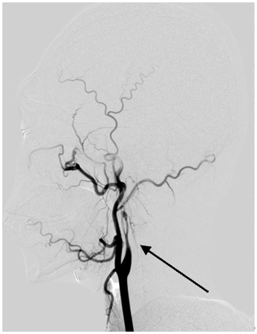 The arrow indicates the vascular changes caused by the left internal carotid artery dissection as imaged by DSA.