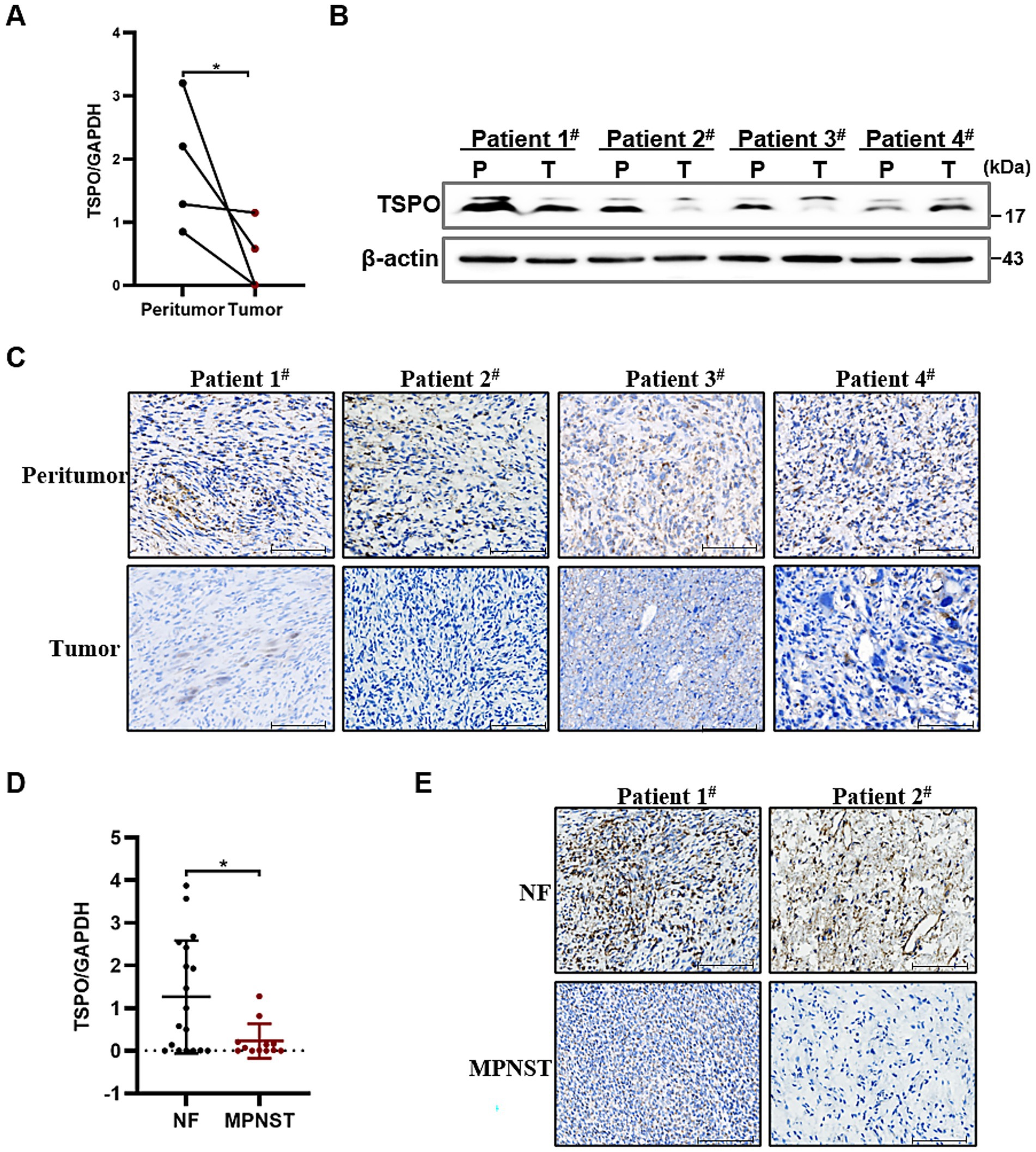 Graphical figures and images depict TSPO expression analysis. Panel A: Line graph showing TSPO/GAPDH ratio comparison between peritumor and tumor samples, indicating significant difference. Panel B: Western blot of TSPO and β-actin for four patients, comparing peritumor (P) and tumor (T) tissues. Panel C: Immunohistochemical staining images of peritumor and tumor tissues for four patients, highlighting TSPO expression. Panel D: Scatter plot comparing TSPO/GAPDH ratio between neurofibroma (NF) and malignant peripheral nerve sheath tumors (MPNST), showing significant difference. Panel E: Immunohistochemical staining images of NF and MPNST tissues from two patients, demonstrating TSPO expression levels.