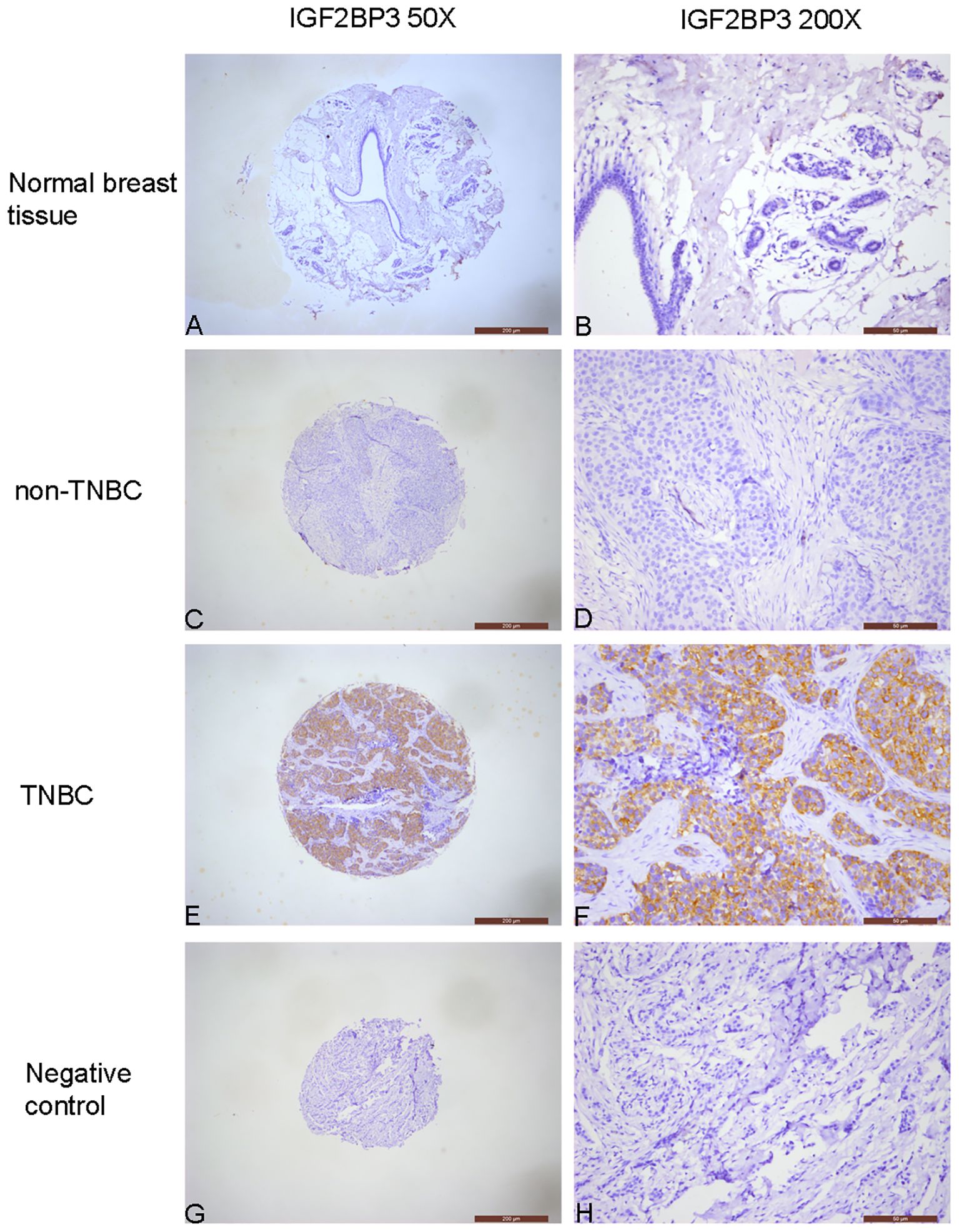 Microscopic images showing IGF2BP3 staining in various breast tissues at two magnifications. Row A-B: Normal breast tissue with minimal staining. Row C-D: Non-TNBC with moderate staining. Row E-F: TNBC with intense staining. Row G-H: Negative control with no staining.