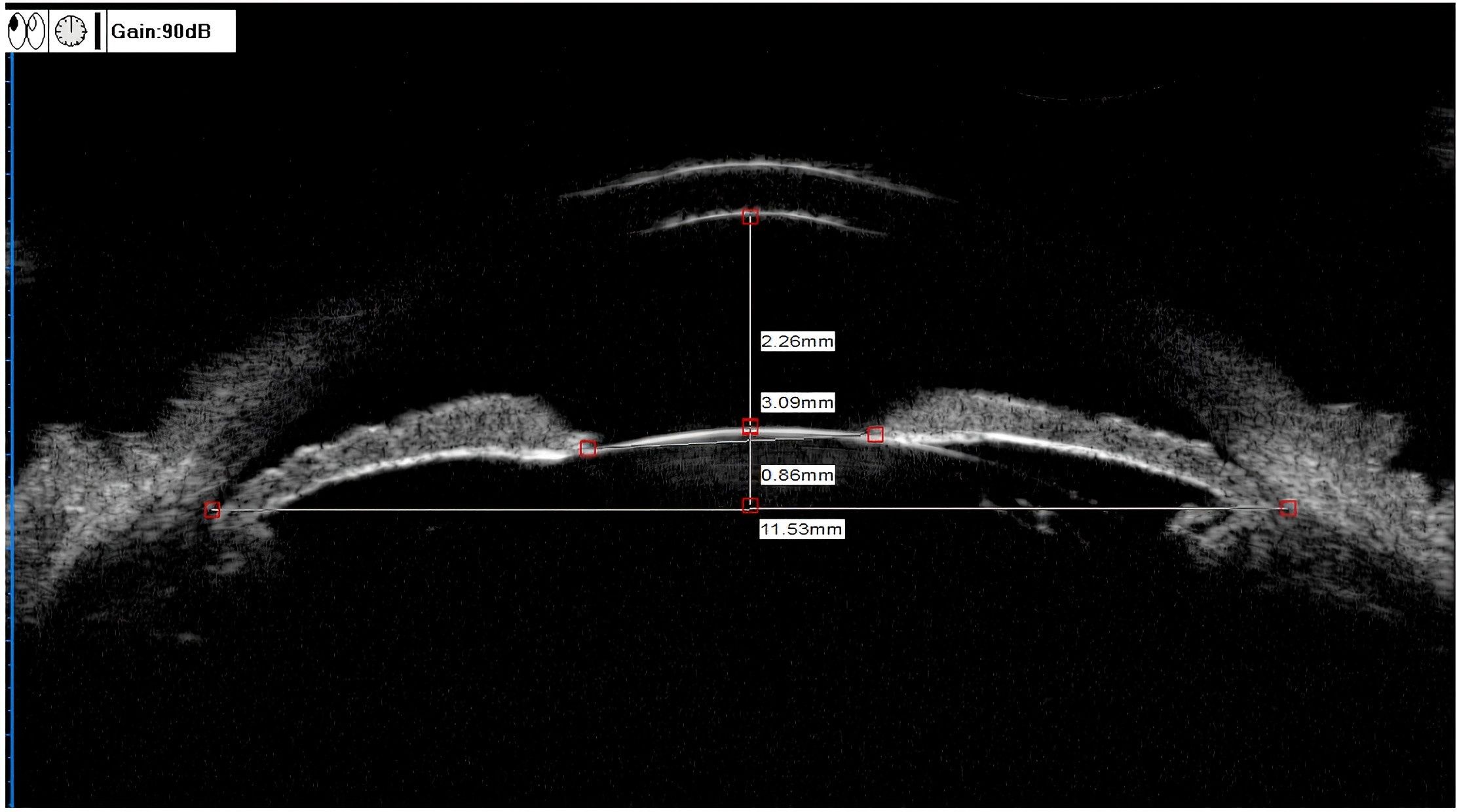 Ultrasound image of an eye showing cross-sectional structures with measurements. The image indicates distances of 2.26 mm, 3.09 mm, 0.86 mm, and 11.53 mm at various points. Gain set at 90 dB.