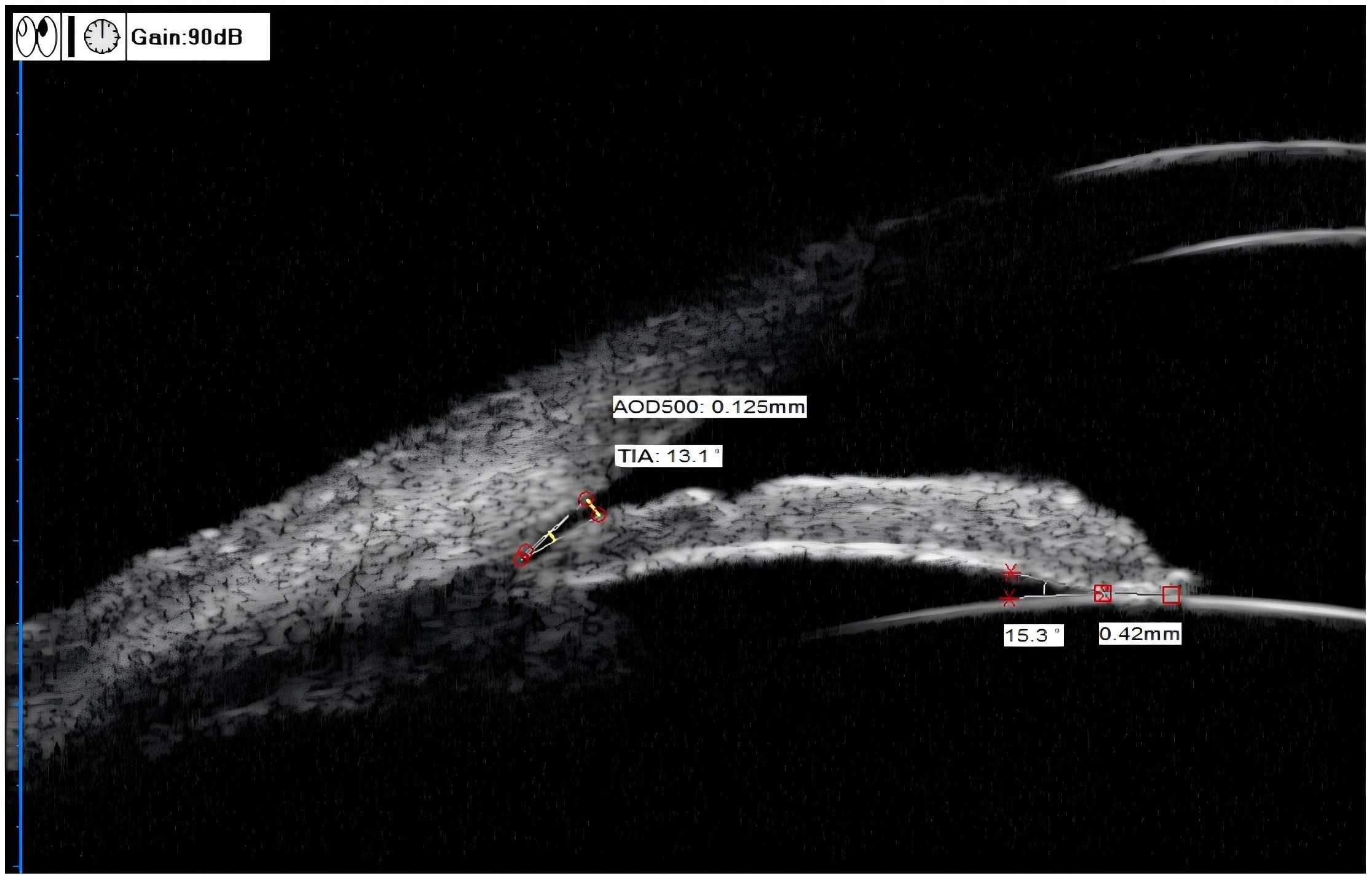 An ultrasound image displays a twisted blood vessel with measurements. The annotations read “AOD500: 0.125mm” and “TIA: 13.1°”, possibly indicating angles or dimensions of interest. Gain is at 90 decibels. The background is dark, emphasizing the vessel.