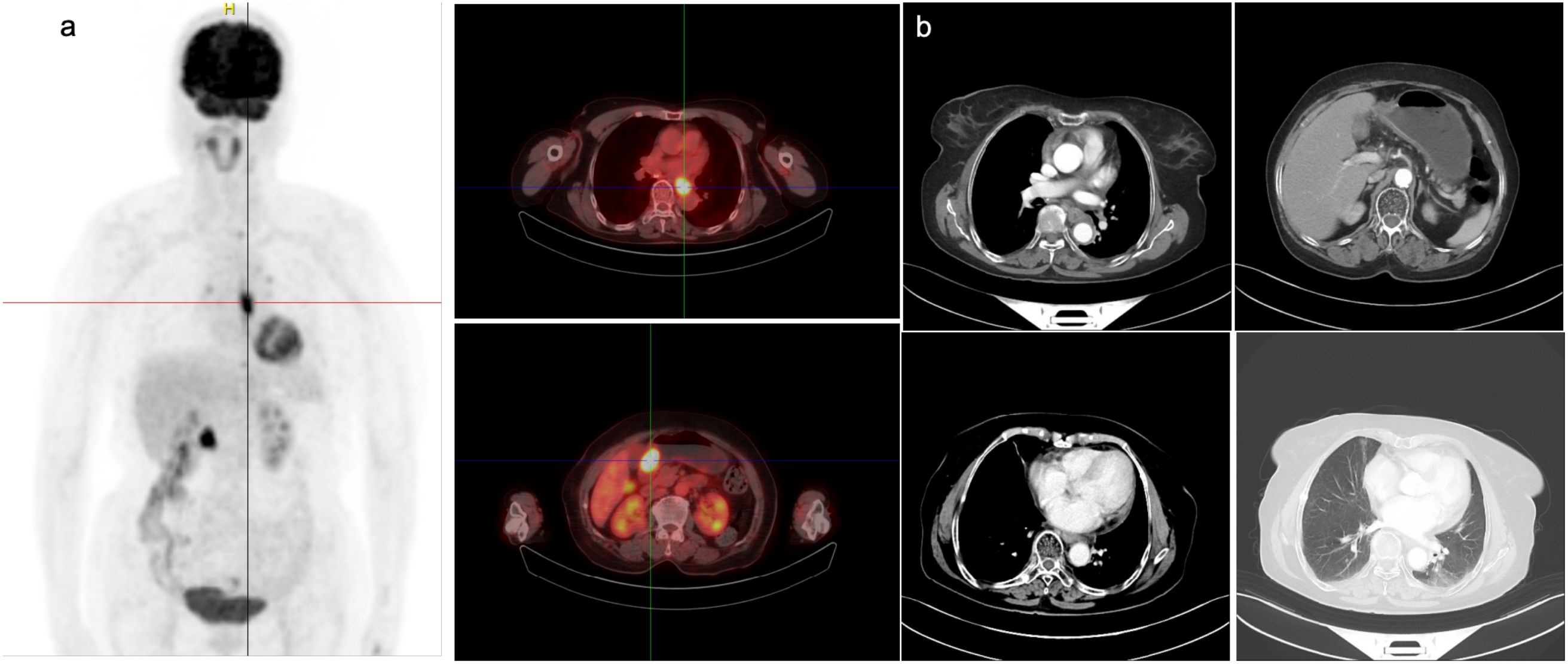 Medical imaging with two panels labeled a and b. Panel a shows a full-body PET scan with highlighted areas indicating activity levels. Panel b consists of four CT scans of the chest and abdomen, displaying different tissue densities and structures.