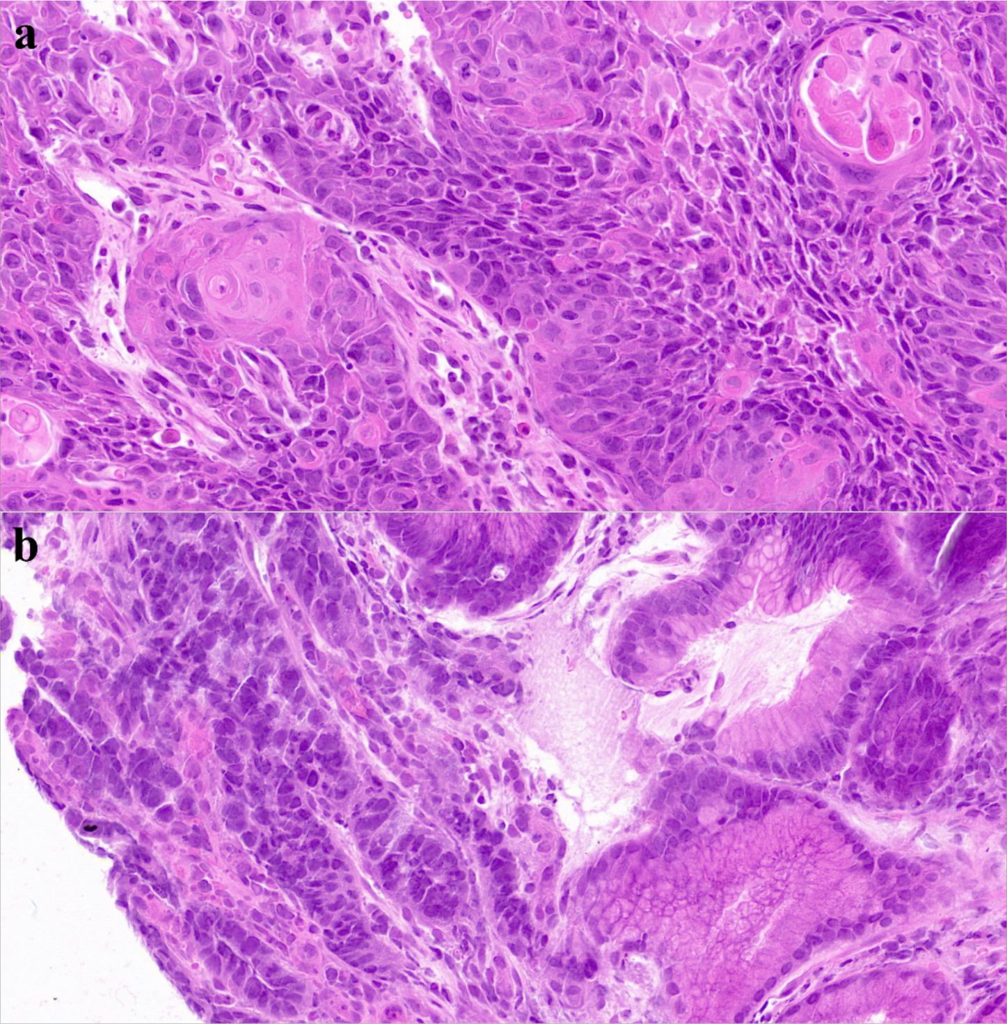 Microscopic images labeled “a” and “b” show tissue sections with densely packed cells stained in varying shades of purple and pink. Image “a” highlights irregular cell shapes and clusters, while “b” shows a more fibrous structure.