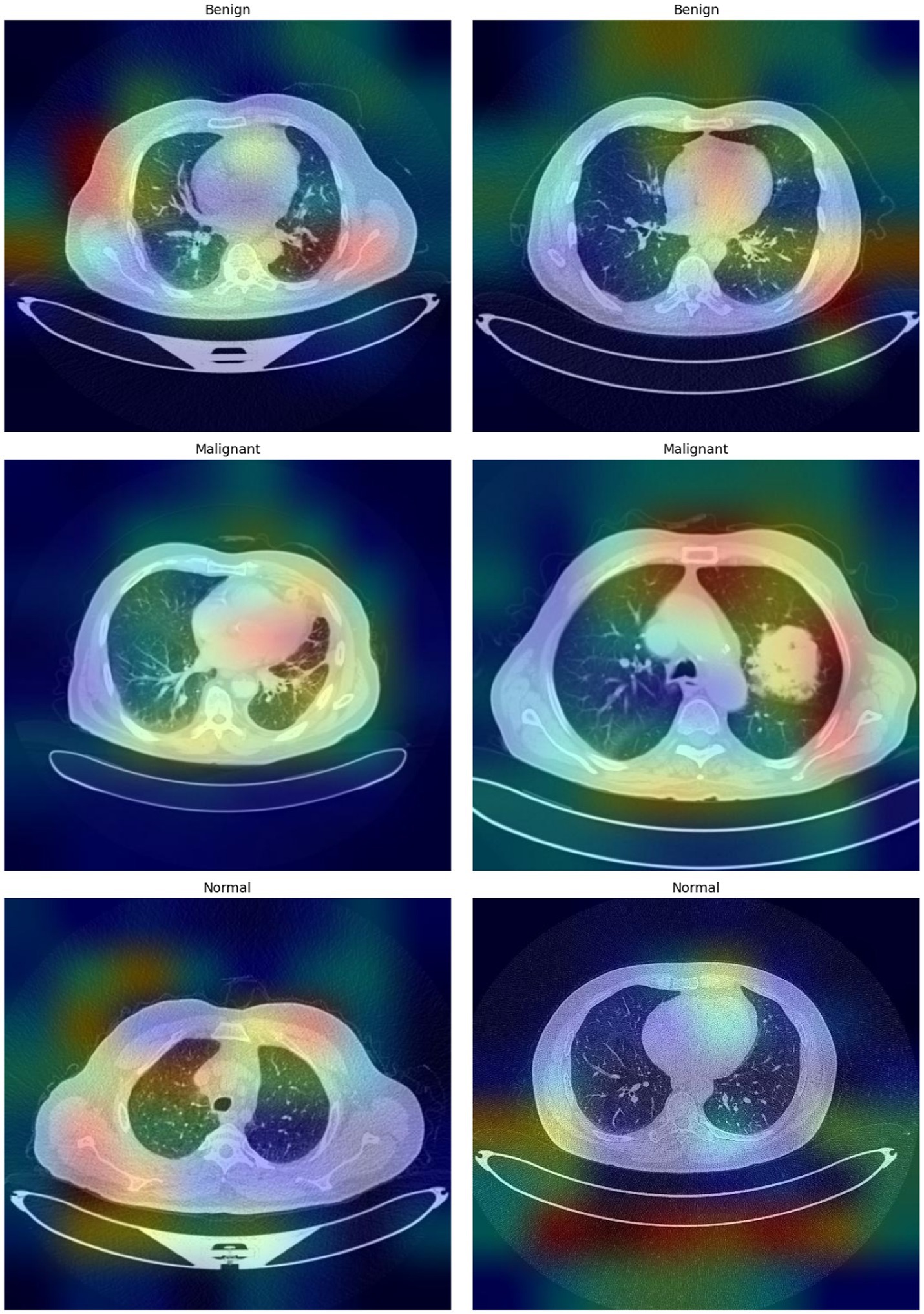 Six CT scan images show cross-sections of the chest with different labels: two labeled
