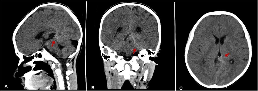 Three CT brain scans labeled A, B, and C. Each scan highlights a specific region with a red arrow. The scans depict different angles: A is sagittal, B is coronal, and C is axial, focusing on intracranial details.