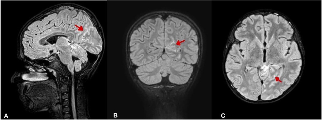 Three MRI brain scans showing a sagittal view (A), coronal view (B), and axial view (C). Each image has a red arrow pointing to a specific area of interest, indicating possible abnormality or region of focus.