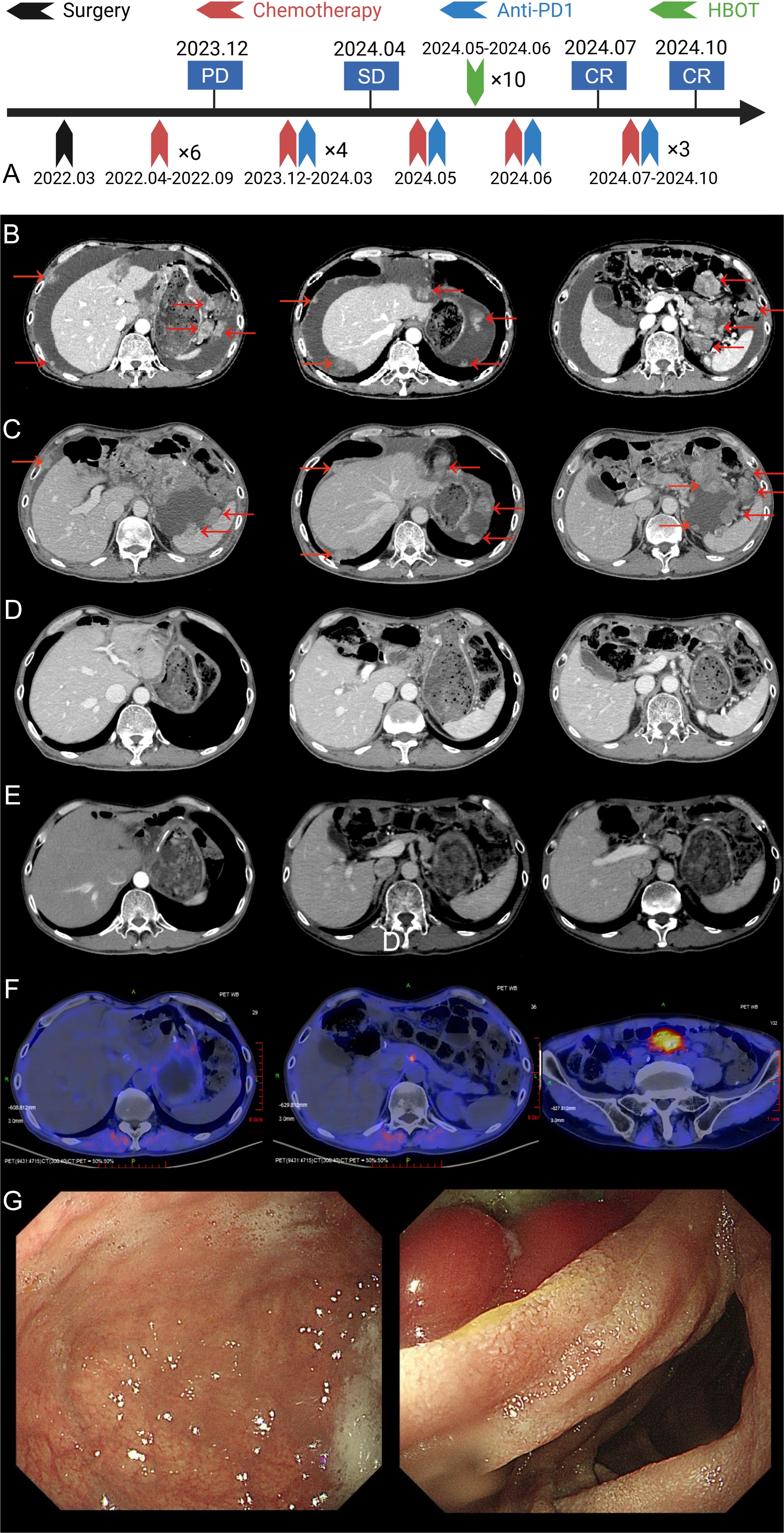 A series of medical images and diagrams: A. Timeline of treatments from March 2022 to October 2024, illustrating surgery, chemotherapy, anti-PD1, and HBOT with outcomes indicated. B-E. Four panels of CT scans showing liver and abdominal regions with red arrows highlighting points of interest. F. Three PET scans highlighting areas of metabolic activity. G. Two gastroscopy images showing the internal lining of the stomach and intestine.
