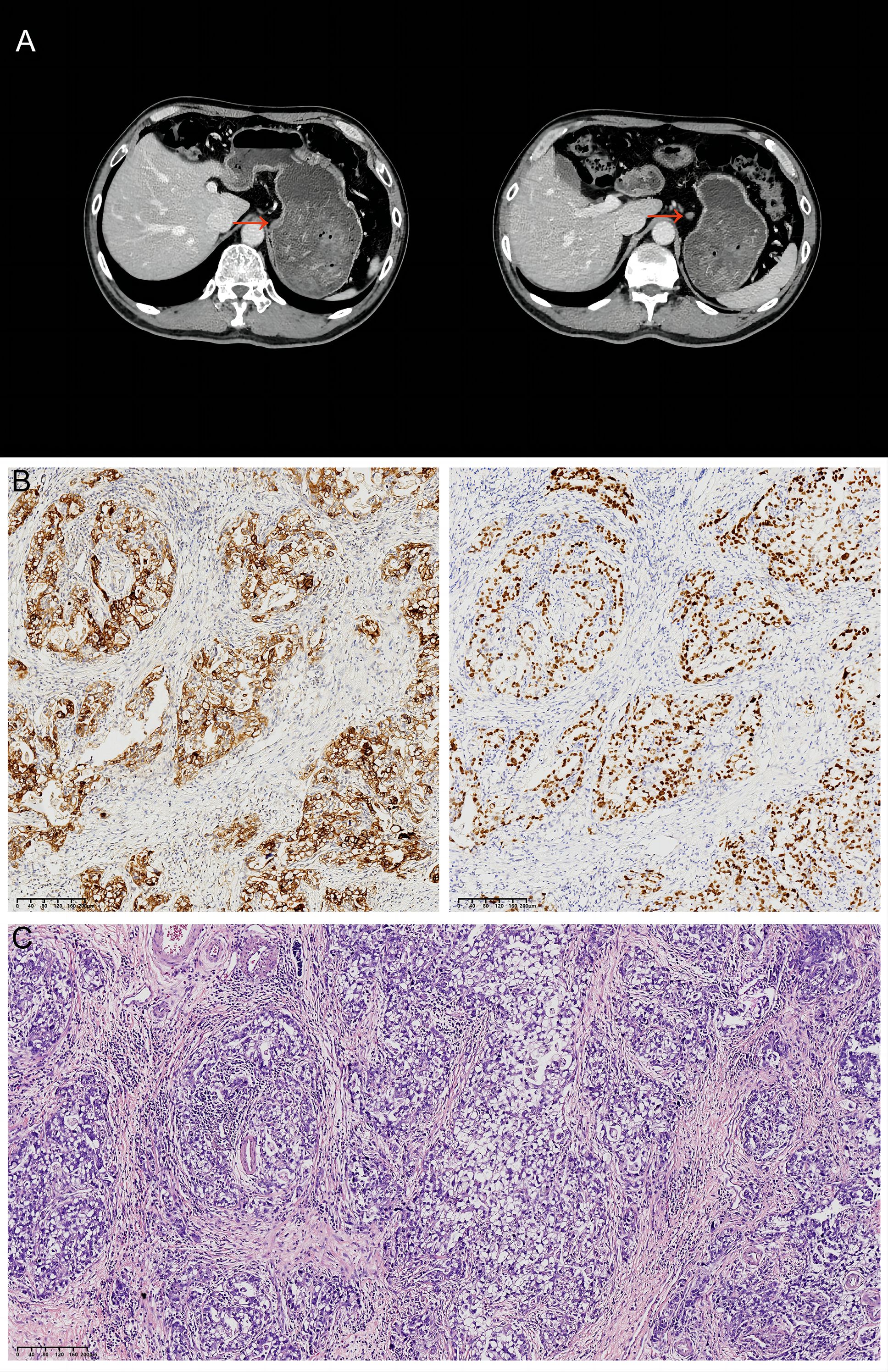 Panel A shows two axial CT scans of the abdomen highlighting a lesion in the liver with a red arrow. Panel B presents two histological sections with brown staining indicating positive immunohistochemical markers. Panel C displays a histopathological section stained with hematoxylin and eosin, showing tissue architecture and cellular details.