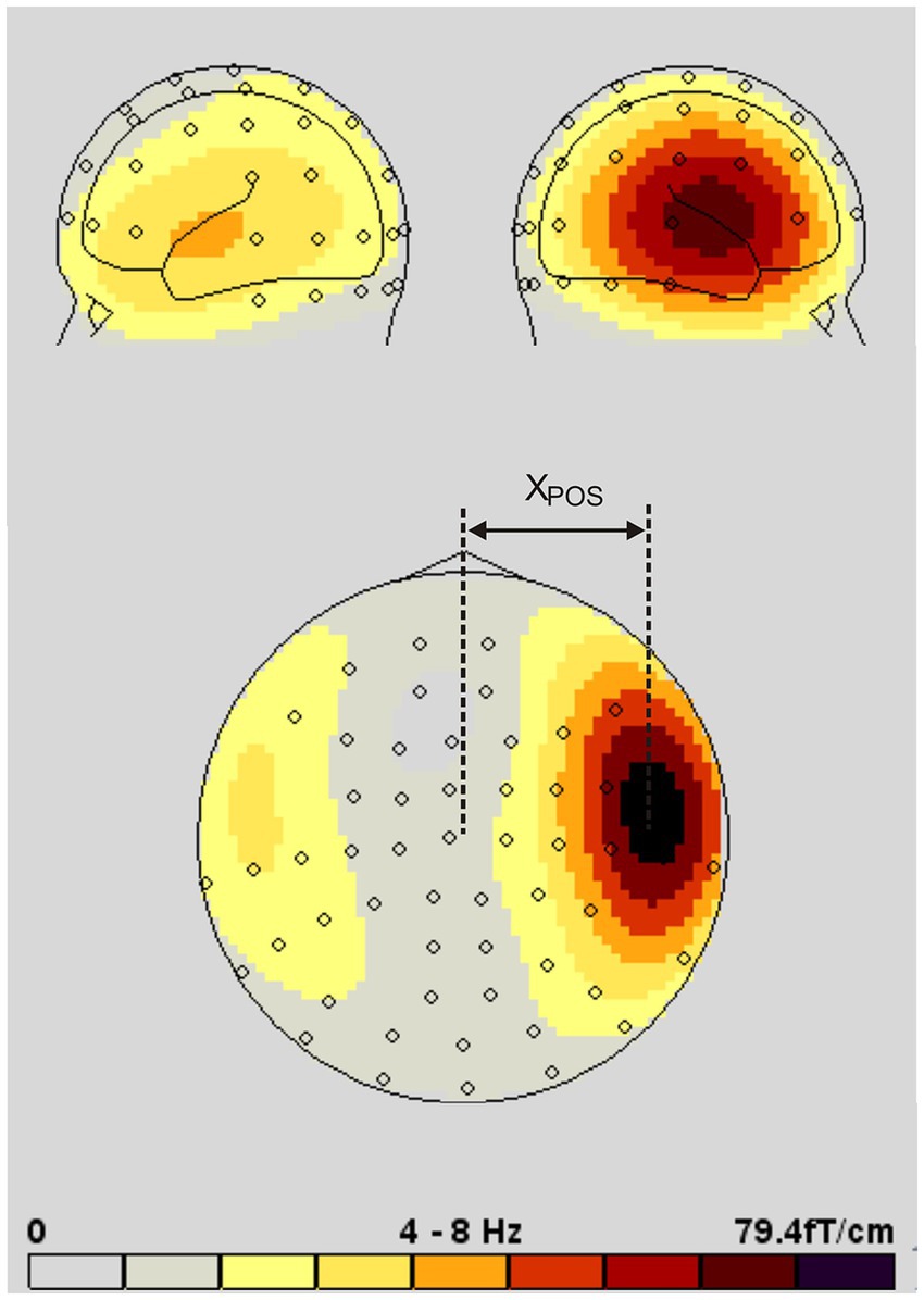 Topographic map depicting brain activity in three views: two side views and one top view. Colors range from yellow to dark red, indicating varying levels of magnetic field strength from 0 to 79.4 femtotesla per centimeter at 4 to 8 Hertz. Labels and a color scale are included.